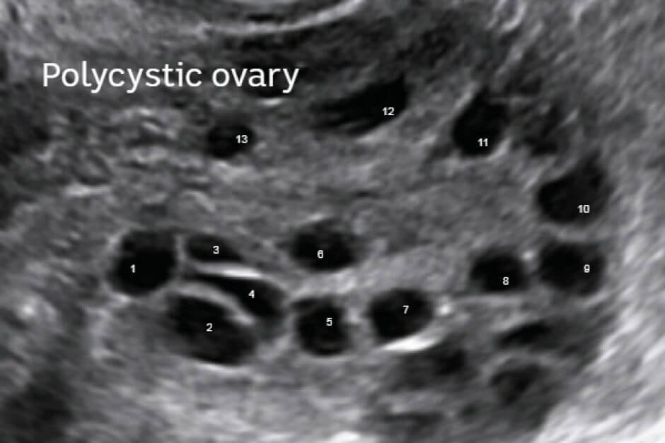 Polycystic Ovary - Ultrasound for PCOS - ultrasound image of Polycystic ovary